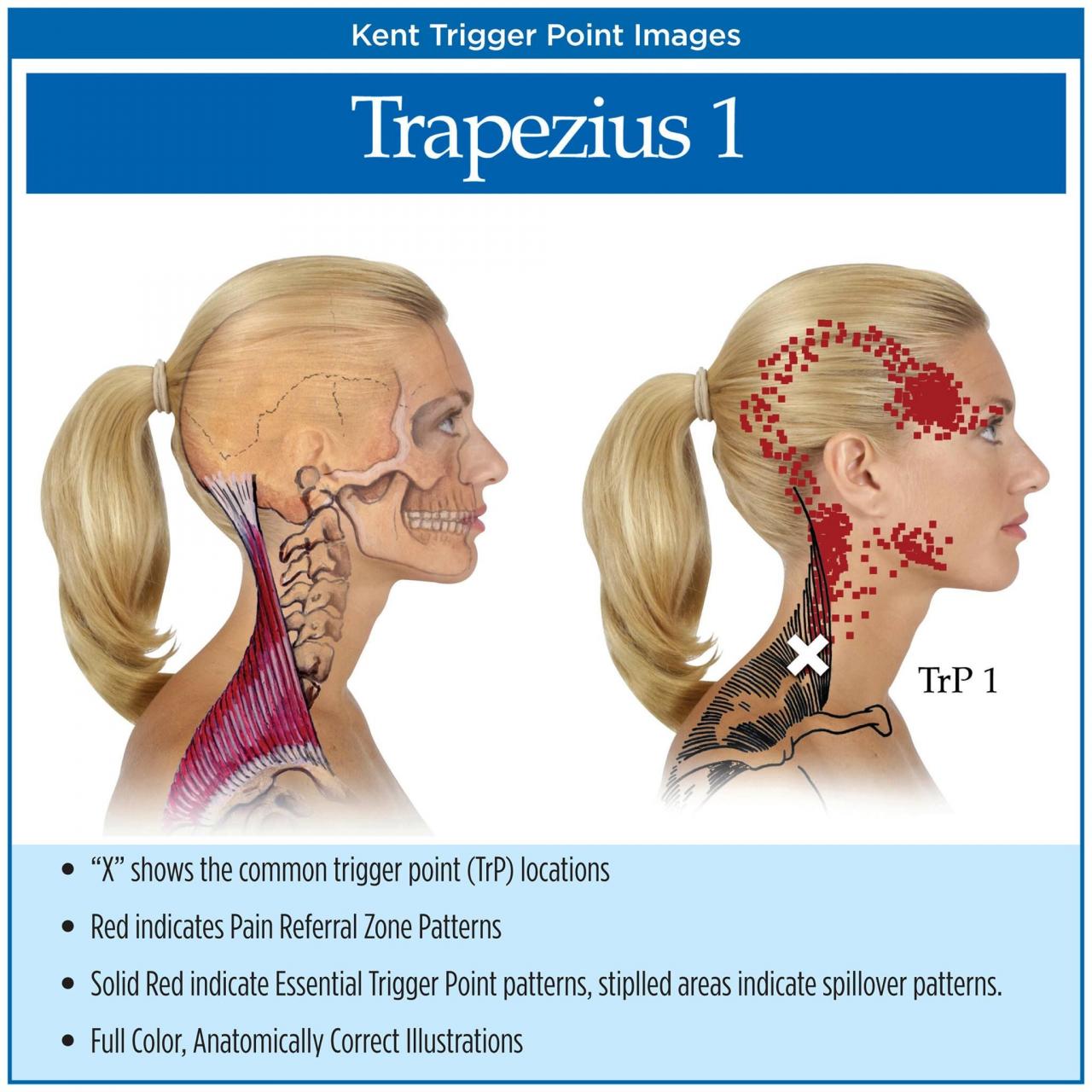 Brachial plexus nerve muscles posterior traumatic nerves hughston elbow causes